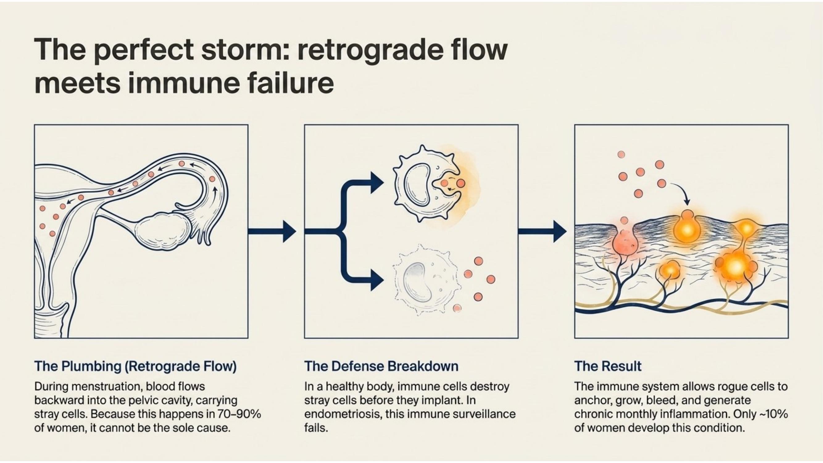 Diagram explaining retrograde menstruation as a leading theory of endometriosis