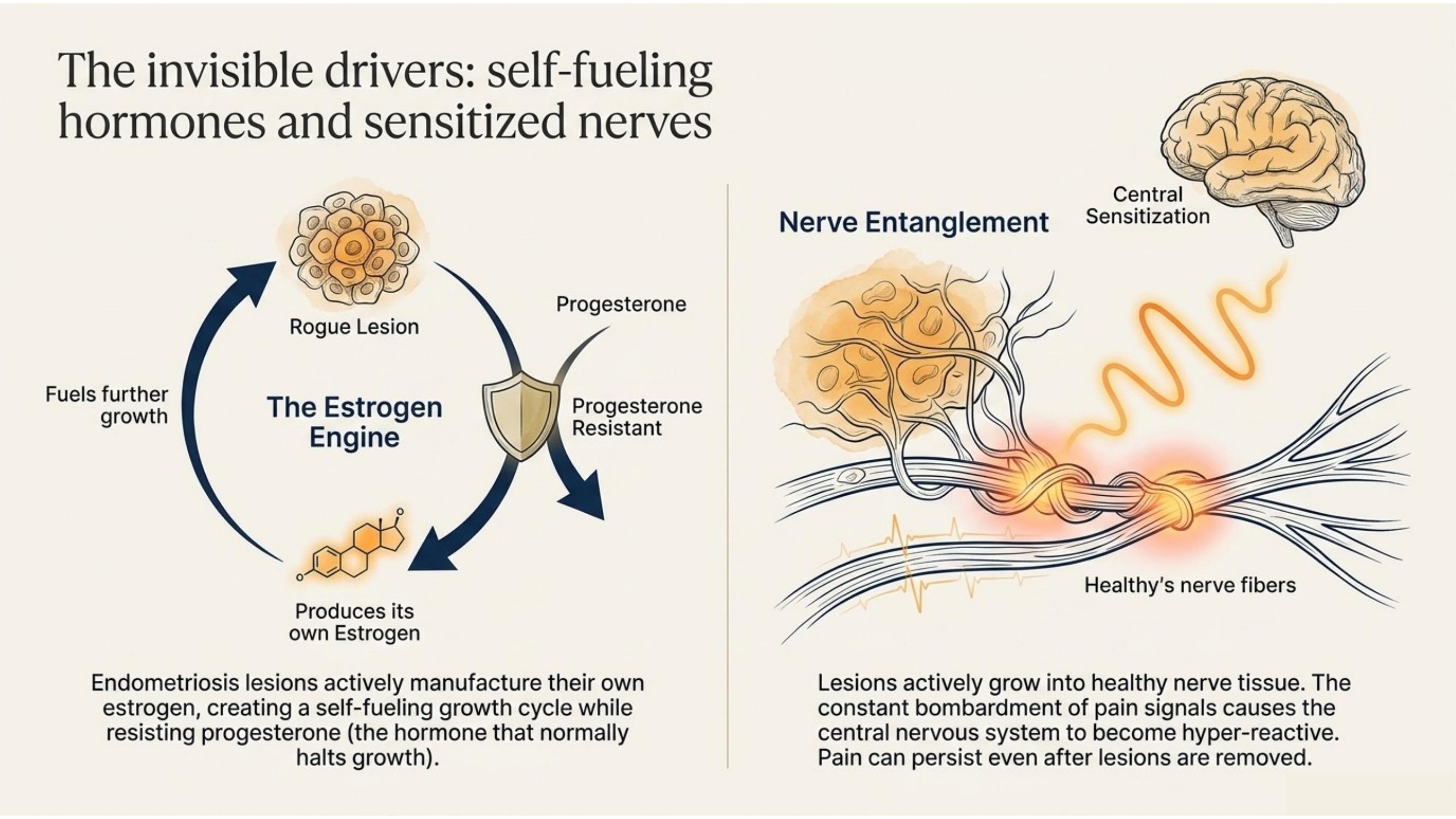 Diagram showing immune dysfunction, hormone dependence, and oxidative stress in endometriosis